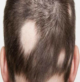 alopecia-areata-treatment