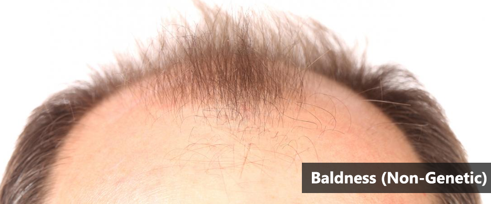baldness-banner
