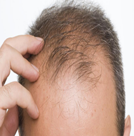 experiencing-hair-loss